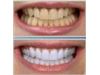 لاک سفید کننده دندان   لاک سفید کننده دندان