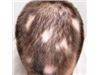 ریزش موی سکه ای  Alopecia areata  